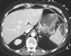 Splenic Infarct With Abscess - CTisus CT Scan