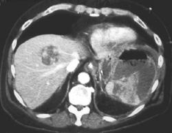 Splenic Abscess - CTisus CT Scan