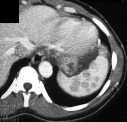 Sarcoidosis - CTisus CT Scan