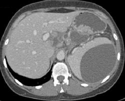 Splenic Pseudocyst - CTisus CT Scan