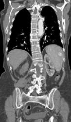 Splenic Hemangioma - CTisus CT Scan