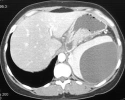 Splenic Pseudocyst/subcapsular - CTisus CT Scan