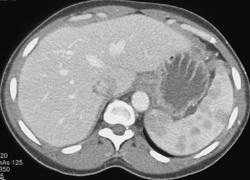 Sarcoid Vs Lymphoma - CTisus CT Scan