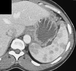 Lesions Only Seen on Venous Phase Imaging - CTisus CT Scan