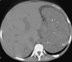 Klippel-Trenaunay-Weber (KTW) Syndrome-splenic Hemangioma - CTisus CT Scan