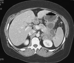 Pancreatic Cancer Invades the Splenic Vessels and Spleen - CTisus CT Scan