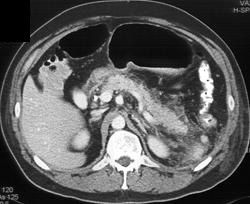 Splenic Involvement By Pancreatitis - CTisus CT Scan