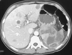 Islet Cell Tumor Invades the Spleen - CTisus CT Scan