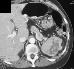 Splenic Abscess - CTisus CT Scan