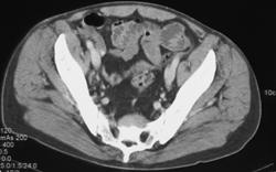 Extramedullary Hematopoesis - CTisus CT Scan