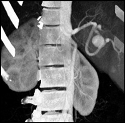 Splenic Artery Aneurysm - CTisus CT Scan