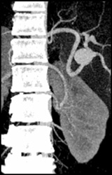 Splenic Artery Aneurysm - CTisus CT Scan