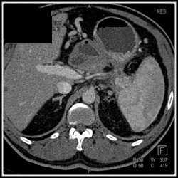 Occluded Splenic Vein Due to Pancreatitis - CTisus CT Scan