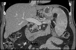 Chronic Pancreatitis With Splenic Vein Occlusion - CTisus CT Scan