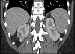 Splenomegaly With Scarred Kidneys - CTisus CT Scan