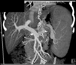 Cirrhosis With Varices - CTisus CT Scan