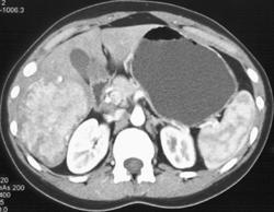 Normal Spleen Hepatoma - Spleen Case Studies - CTisus CT Scanning