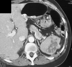 Splenic Abscess - CTisus CT Scan