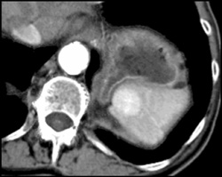 Hemangioma - CTisus CT Scan