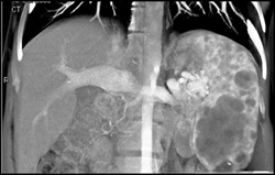 Multiple Hemangiomas - CTisus CT Scan