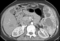 Multiple Splenic Hemangiomas - CTisus CT Scan