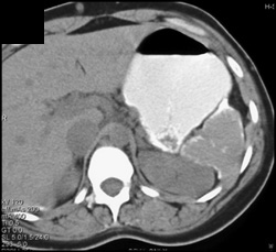 Calcified Spleen-autoinfarction - CTisus CT Scan