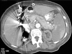 Splenic Infarction - CTisus CT Scan