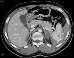 Splenic Laceration - CTisus CT Scan