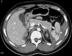 Splenic Laceration - CTisus CT Scan