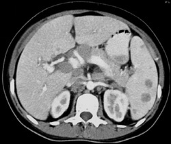 Splenic Lymphoma - CTisus CT Scan