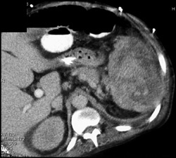 Splenic Abscess - CTisus CT Scan