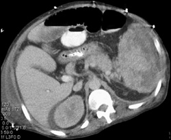 Splenic Abscess - CTisus CT Scan