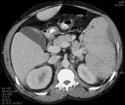 Lymphoma - CTisus CT Scan