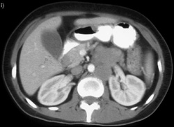 Lymphoma - CTisus CT Scan