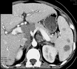 Splenic Lymphoma Adn Adenopathy - CTisus CT Scan