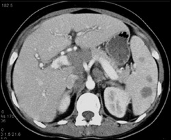 Splenic Lymphoma - CTisus CT Scan