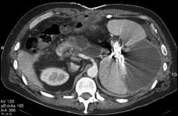 Splenic Infarct S/P Embolization - CTisus CT Scan