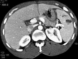 Splenic Laceration - CTisus CT Scan