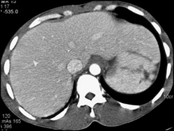 Splenic Laceration - CTisus CT Scan