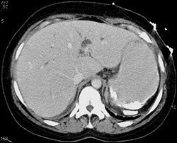 Splenic Infarction - CTisus CT Scan