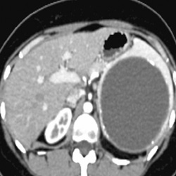 Splenic Cyst - CTisus CT Scan