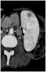 Splenic Lymphoma - CTisus CT Scan