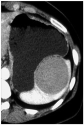 Splenic Hemangioma - CTisus CT Scan