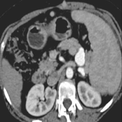 Splenic Artery Aneurysm - CTisus CT Scan