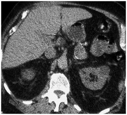 Splenic Artery Aneurysm - CTisus CT Scan