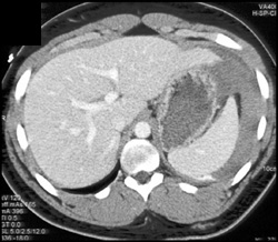 Splenic Laceration - CTisus CT Scan