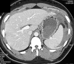 Splenic Laceration - CTisus CT Scan