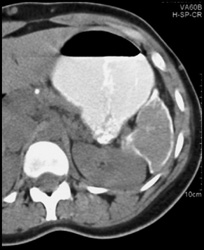 Calcified Rim of Spleen - CTisus CT Scan