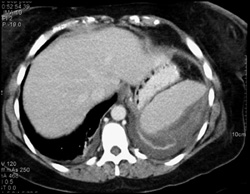 Splenic Laceration - CTisus CT Scan