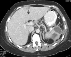 Pseudocysts Involve Spleen - CTisus CT Scan